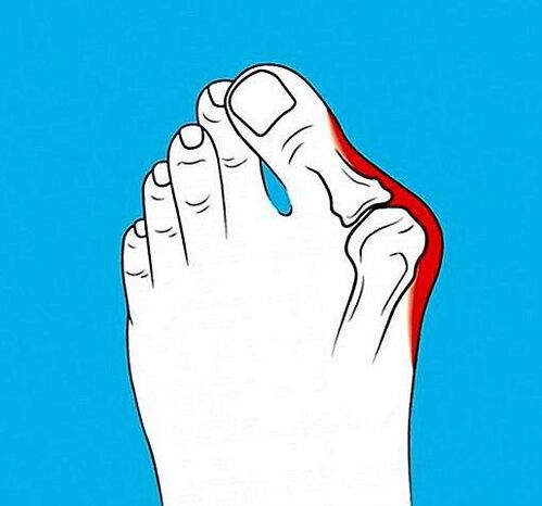 Artrose da articulación do dedo do pé