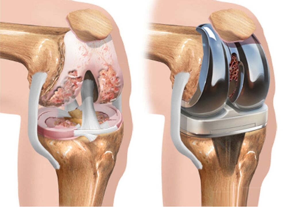 antes e despois da artrose da articulación do xeonllo na artrose