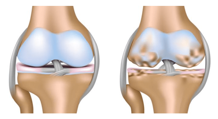 cartilaxe saudable e danos na articulación do xeonllo na artrose