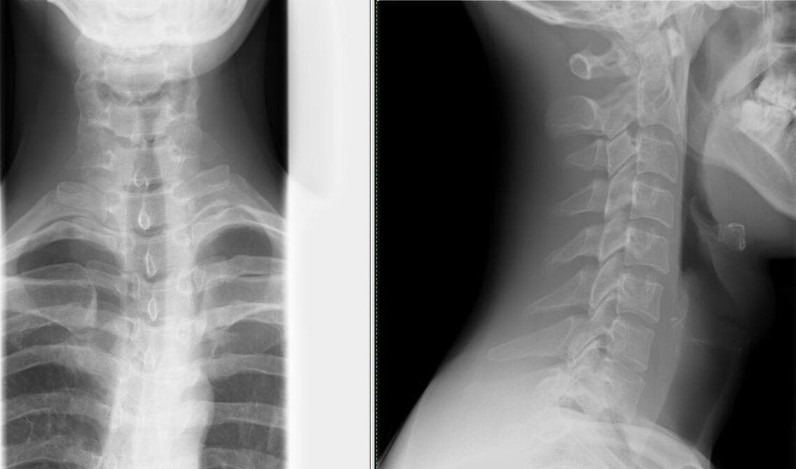 A radiografía da columna vertebral é un método sinxelo e eficaz para diagnosticar a osteocondrose