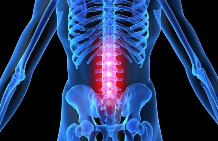 Osteocondrose da rexión lumbar