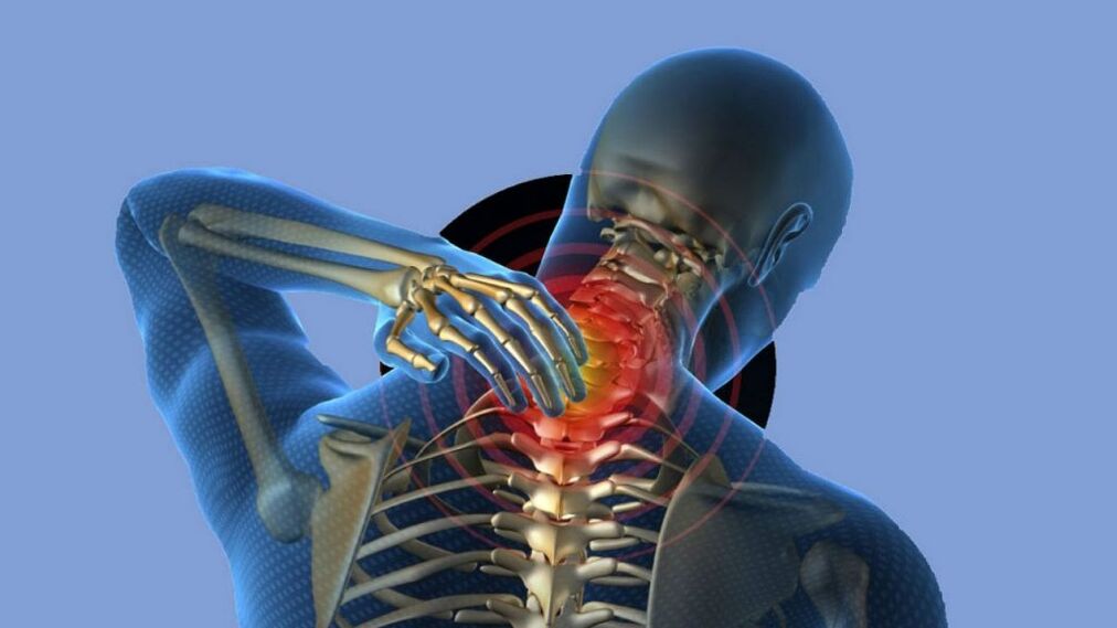 Osteocondrose da rexión do cérvix