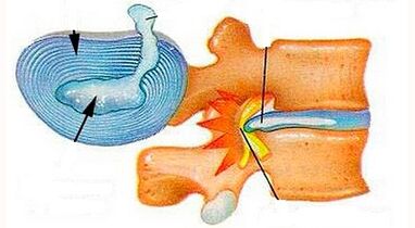 Características do desenvolvemento da osteocondrose do cérvix