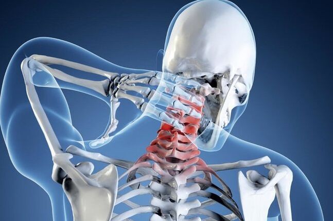 Osteocondrose da columna cervical